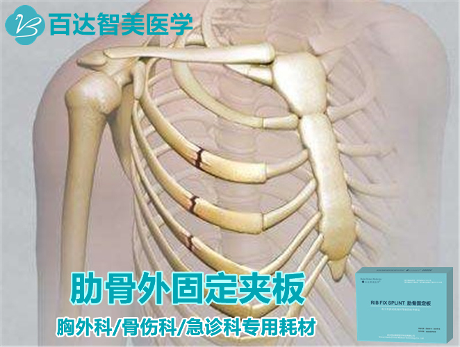 1763430117688549.jpg 肋骨固定夹板图.jpg